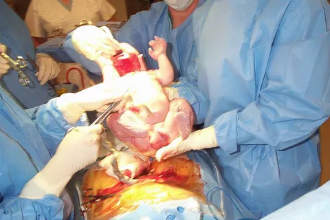 A view of birth by caesarian section: this is the photographer's son as the cord was clamped.