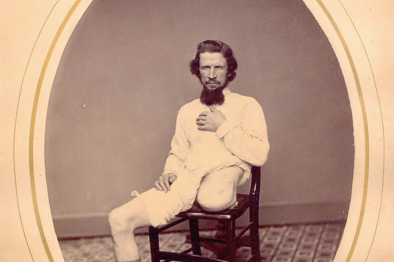 Pvt. George Lemon (CP 191), National Museum of Health and Medicine Description: Image of George Lemon, Co. C, 6th Maryland Volunteers. . George Lemon, Co. C, 6th Maryland Volunteers. Injured 5 May 1864 at the Battle of Wilderness, Va. Photograph taken 30 months after amputation at hip joint. Treated by E. Bentley. Contributed by E.D. Hudson on 15 April 1868. Case history: “George W. Lemon. Gunshot fracture of femur of left hip joint. Amputation. George W. Lemon, private Co. C, 6th Md., Vols., aged 31 years. Admitted to Harewood U.S. General Hospital from Slough Gen’l Hospital, Alexandria, Va., January 31st, 1866. Convalescent from amputation at the left hip joint—the result of gunshot fracture of the femur, received in battle at the Wilderness, May 5th, 1864. After wounding he was left upon the field and taken by the rebels to a hospital in the vicinity—where he lay several days without any attention whatever until the Hospital was retaken by our forces, and then he seems to have had very little surgical attention, for according to his statement his limb was lying at large in the bed, no attempt to keep it in position ever having been made by his medical attendants until Oct. 11th 1864, when he was removed to Slough Hospital, Alexandria, Va., where he remained with his leg in a greatly deformed condition until Oct. 12th 1865, when amputation at the hip joint was performed by Surgeon E. Bently, U.S. Vols., in charge of the Hospital. At the time of his admission to this Hospital January 31st, 1866, he was quite well and able to go about wherever he chose on crutches. His hip was quite healed, and he was discharged from the U.S. Service February 3rd, 1866, at his own request.” Date: 1868 Photo ID: CP 191 Source Collection: OHA 75: Contributed Photographs Repository: National Museum of Health and Medicine, Otis Historical Archives Related Material: CP 191, CP 1118, CP 1314, SP 136, SP 137 Rights: No known restrictions upon publication, physical copy retained by the National Museum of Health and Medicine. Publication and high resolution requests should be directed to NMHM (<a href=" http://www.medicalmuseum.mil " rel="nofollow">www.medicalmuseum.mil</a>).